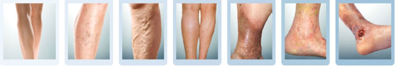 etapas do desenvolvemento das varices das pernas