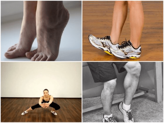as varices causan dor nas pernas