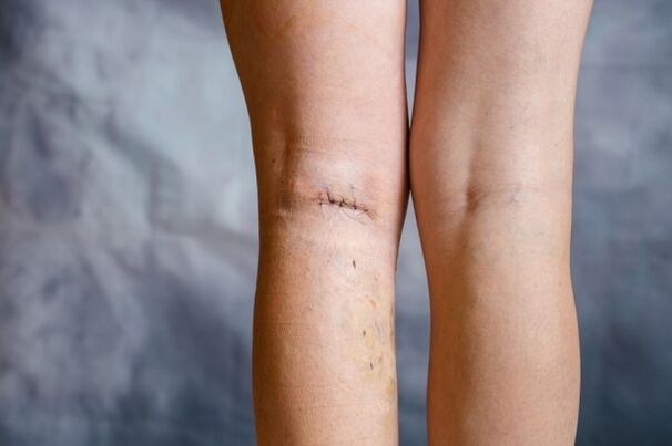 costura na perna despois da cirurxía de varices