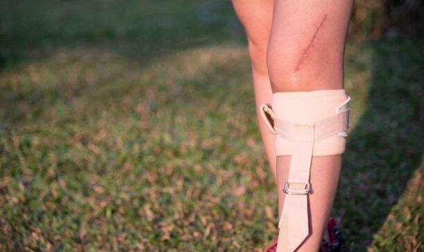 restauración de pernas despois da cirurxía de varices