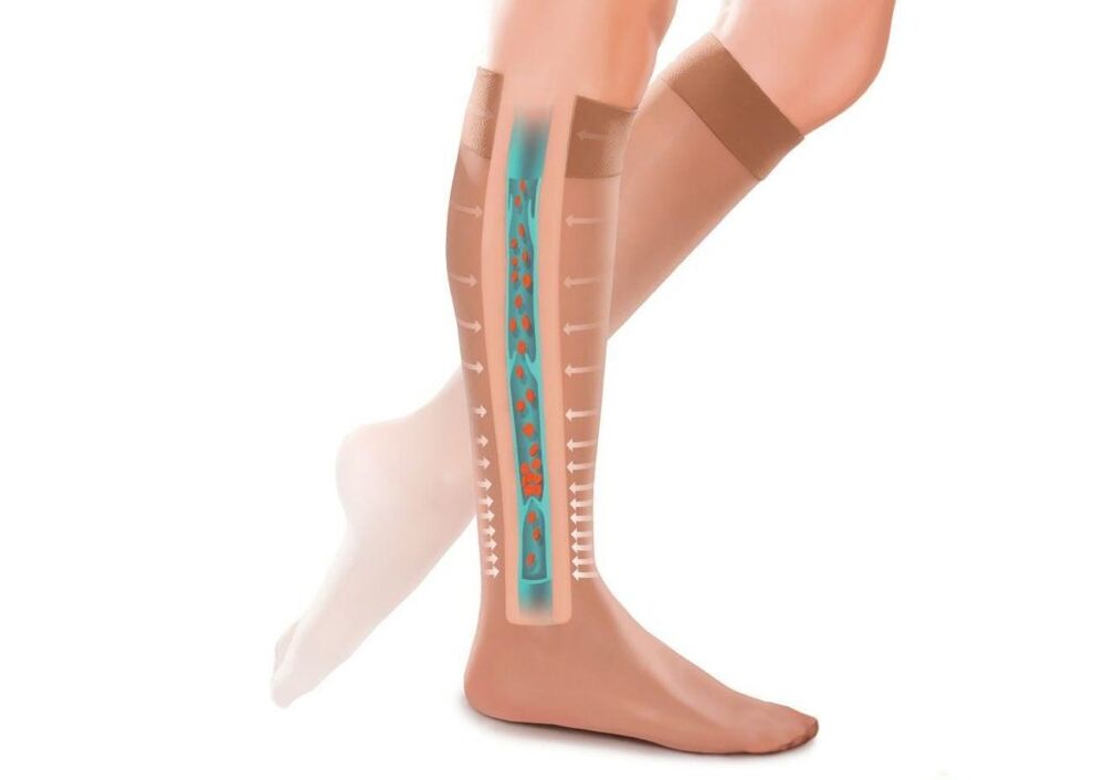 o efecto das medias de compresión nas pernas con varices