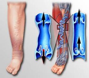 fluxo sanguíneo na perna con varices