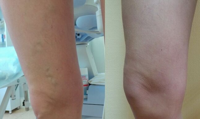 perna antes e despois do tratamento de varices reticulares
