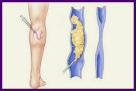 A escleroterapia é un método popular para desfacerse das varices nas pernas