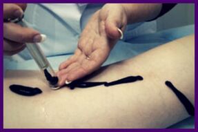 O procedemento para tratar as varices con sanguijuelas (hirudoterapia)