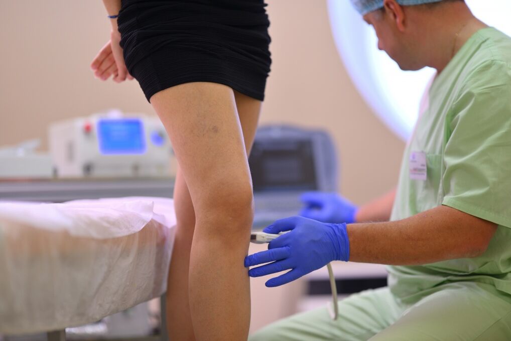 tratamento de varices nas pernas