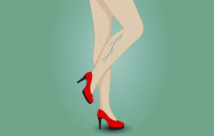 Varices nas pernas dunha muller