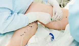 métodos de tratamento de varices nas pernas nas mulleres