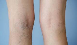 signos de varices nas pernas nas mulleres